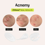 Acnemy ZITLESS® Patch With Microdarts For Early-Stage Pimple. Plaastrid varajaseks akne ennetamiseks 5 x 0,65mg