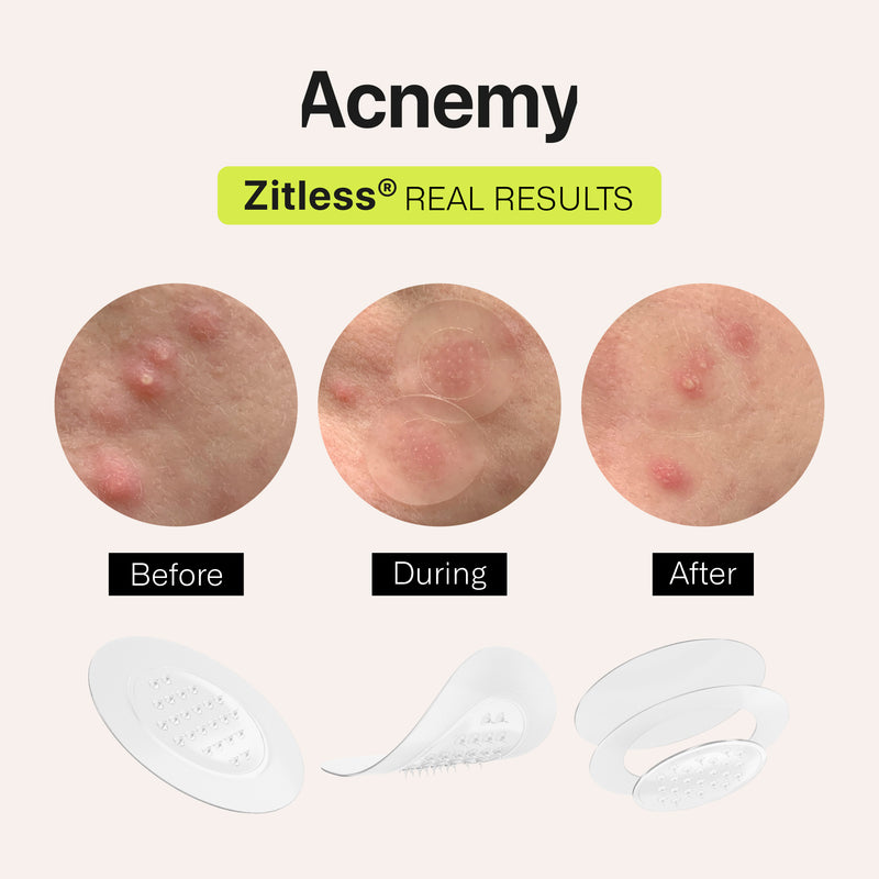 Acnemy ZITLESS® Patch With Microdarts For Early-Stage Pimple. Plaastrid varajaseks akne ennetamiseks 5 x 0,65mg