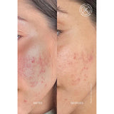 Theramid AZID Azelaic Acid 15% Treatment. Aselaiinhappe hooldusseerum 30ml