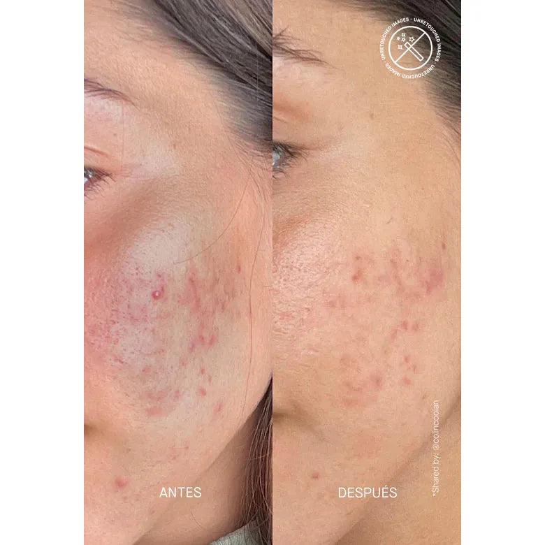 Theramid AZID Azelaic Acid 15% Treatment. Aselaiinhappe hooldusseerum 30ml